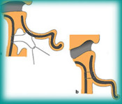 Procedimento da otoplastia