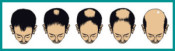 Progressão da Calvície Masculina