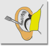 Raspagem Otoplastia