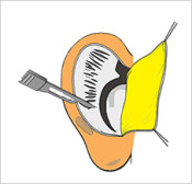 Raspagem Otoplastia