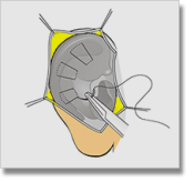 Sutura - Otoplastia