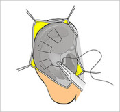Sutura Otoplastia