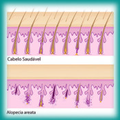 Alopecia Areata