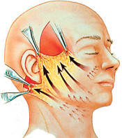 Procedimento do lifting facial