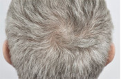 FUE (Follicular Unit Extraction)