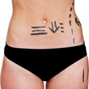 Lipo a Laser