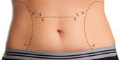 Lipoaspiração