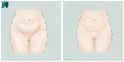 Abdominoplatia em âncora