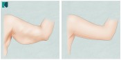 Braquioplastia - Lifting de Braços