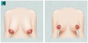Mamoplastia Pós Bariátrica