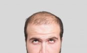 Transplante capilar antes e depois: mitos e verdades